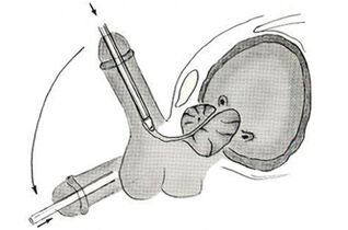 Scheme of endoscopic penis enlargement surgery