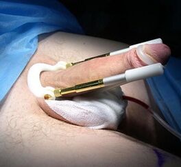 how an operation to increase the penis is performed