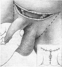 Surgical lengthening of the penis by pulling out its hidden part